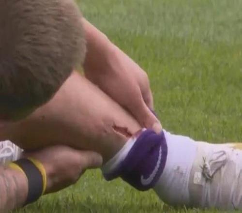 慎入，熱刺舊將霍爾特比在荷甲賽場上小腿被踢出一道血口