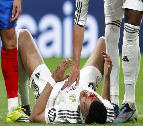 眉骨縫三針，姆巴佩社媒發(fā)布面部受傷部位特寫