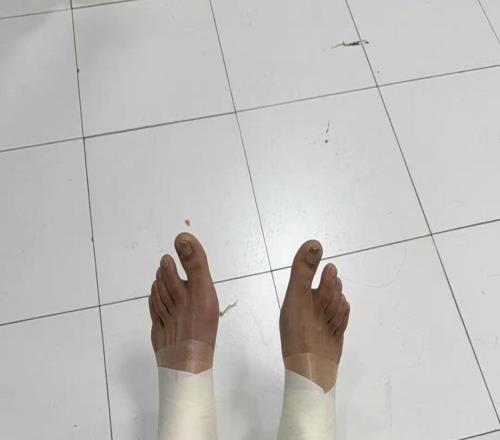 硬漢！32歲老將兩腿全拉傷，纏滿繃帶打20分鐘，媒體人真是拼了