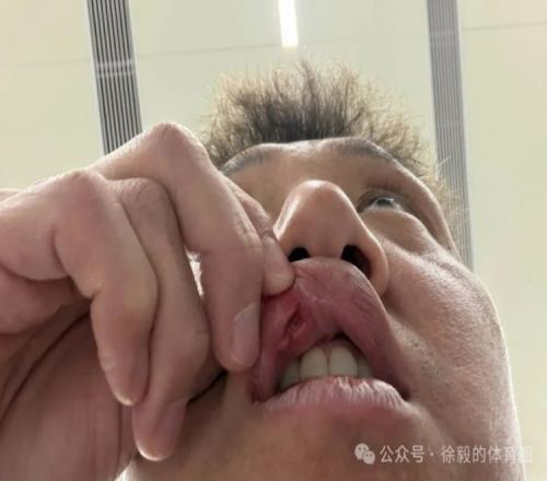 高迪賽后縫合九針昨天很痛今天狀態(tài)不錯(cuò)不想錯(cuò)過對陣申花的比賽_中超直播