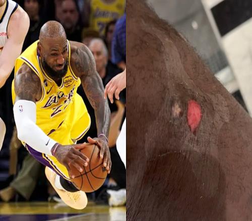 詹姆斯曬傷口喊疼！調(diào)侃今年救球到此結(jié)束祝賀東契奇當(dāng)選周最佳