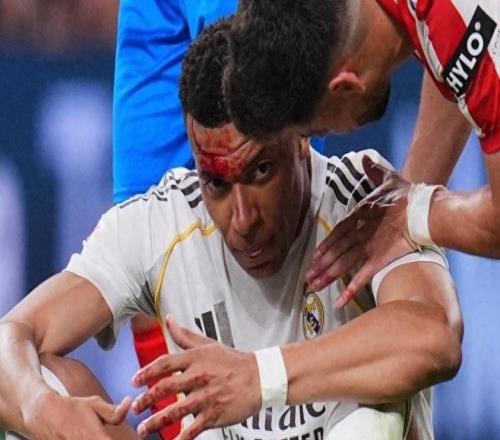 皇馬：姆巴佩眉骨縫合三針缺席歐冠前訓練