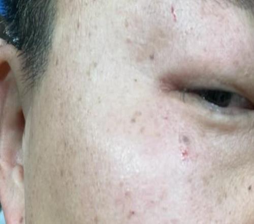 被誤傷，一名國安球迷昨日觀賽遭球悶中面部，并且眼鏡損壞