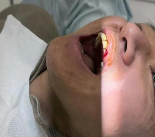 高迪嘴部受伤缝了九针：全力治疗恢复，不想错过与申花的比赛